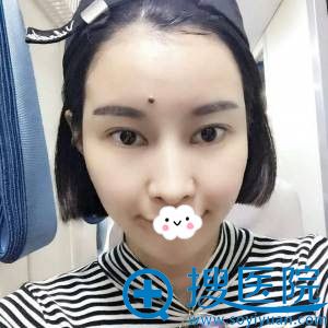 深圳金立自体脂肪丰面真人案例 深圳金立自体脂肪丰面真人案例