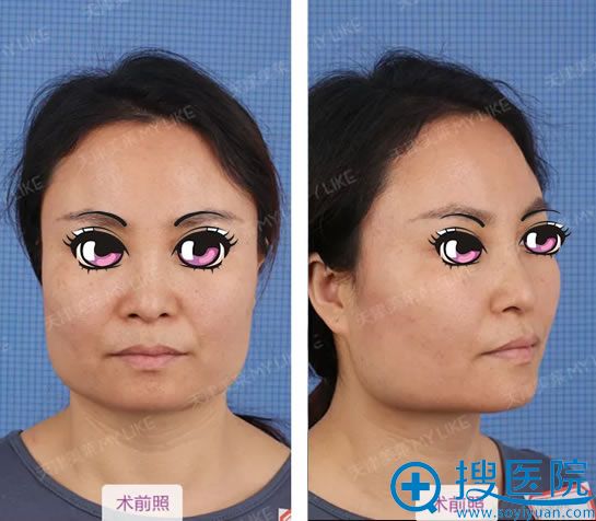 在天津公立整容医院面诊后选择天津美莱罗金超做下颌角推颧骨