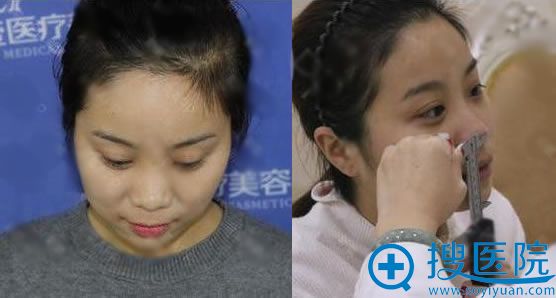 出差时面诊了广州壹加壹回北京找壹加壹王博谦院长做了假体隆鼻