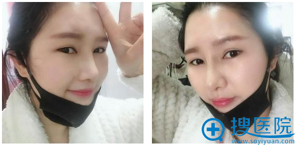 上海丽质整形医院卢九宁做的鼻综合隆鼻术后半个月效果图 上海丽质整形医院卢九宁做的鼻综合隆鼻术后半个月效果图