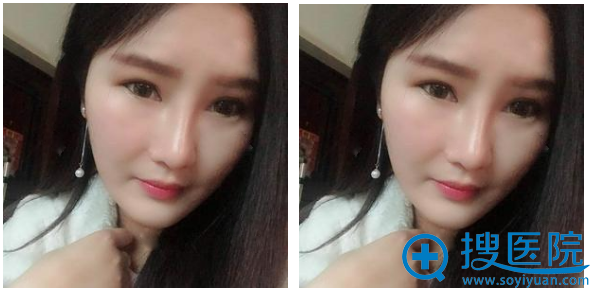 上海丽质整形医院卢九宁隆鼻+提眉术后一个月恢复图片 上海丽质整形医院卢九宁隆鼻+提眉术后一个月恢复图片