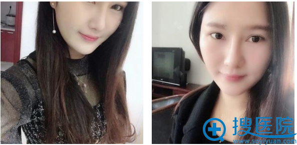 上海丽质整形医院卢九宁鼻综合隆鼻案例术后两个月图片 上海丽质整形医院卢九宁鼻综合隆鼻案例术后两个月图片
