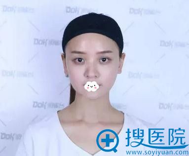 放暑假了妈妈带我到重庆铜雀台做了鼻综合假体隆鼻颜值真高了
