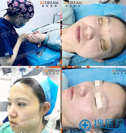 <!--<i data=20240710 data-id=11921></i>-->董香君双眼皮手术过程 <!--<i data=20240710 data-id=11921></i>-->董香君双眼皮手术过程
