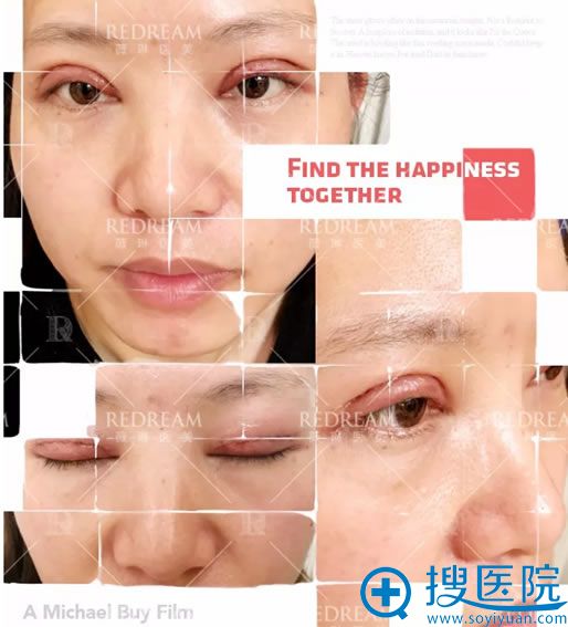 做完双眼皮术后2天换药照片 做完双眼皮术后2天换药照片
