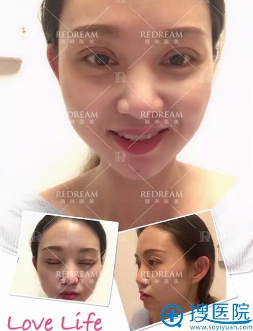 做完双眼皮手术4天恢复效果图 做完双眼皮手术4天恢复效果图