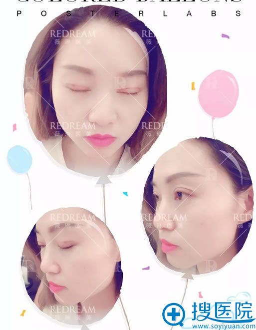 <!--<i data=20240710 data-id=11921></i>-->董香君双眼皮案例6天效果 <!--<i data=20240710 data-id=11921></i>-->董香君双眼皮案例6天效果