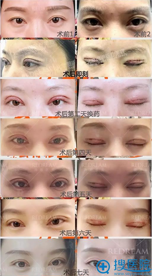 双眼皮手术7天恢复过程图片 双眼皮手术7天恢复过程图片