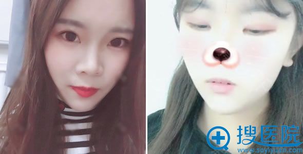金奇龙做双眼皮开眼角案例3个月效果 金奇龙做双眼皮开眼角案例3个月效果