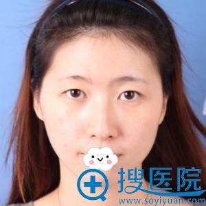 <!--<i data=20240710 data-id=12045></i>-->整形美容医院割双眼皮+开眼角案例 <!--<i data=20240710 data-id=12045></i>-->整形美容医院割双眼皮+开眼角案例