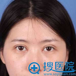 <!--<i data=20240710 data-id=12045></i>-->李鹏割双眼皮+开眼角效果怎么样 <!--<i data=20240710 data-id=12045></i>-->李鹏割双眼皮+开眼角效果怎么样