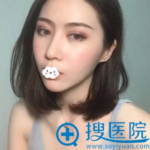 <!--<i data=20240710 data-id=12045></i>-->李鹏双眼皮真人案例 <!--<i data=20240710 data-id=12045></i>-->李鹏双眼皮真人案例