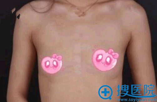 去<!--<i data=20240710 data-id=14413></i>-->假体隆胸前 去<!--<i data=20240710 data-id=14413></i>-->假体隆胸前