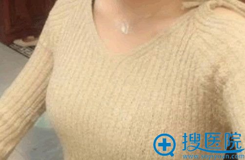柏国芳假体隆胸术后第25天照片 柏国芳假体隆胸术后第25天照片