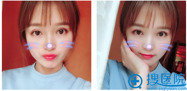 西安美好整形医院何琪医生双眼皮案例两个月效果图 西安美好整形医院何琪医生双眼皮案例两个月效果图