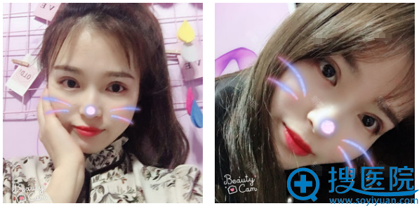 找西安美好整形医院何琪医生做完双眼皮半个月了 找西安美好整形医院何琪医生做完双眼皮半个月了