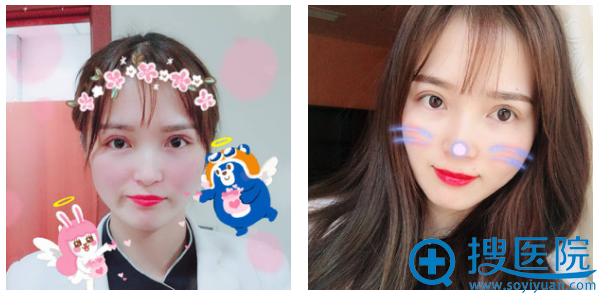 西安美好整形医院何琪医生双眼皮术后七天效果图 西安美好整形医院何琪医生双眼皮术后七天效果图