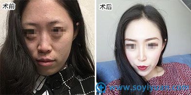西安晶肤医疗美容埋线提升案例 西安晶肤医疗美容埋线提升案例