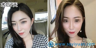 西安晶肤医疗美容埋线提升案例 西安晶肤医疗美容埋线提升案例