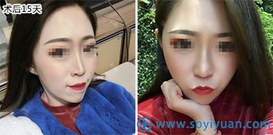 西安晶肤医疗美容埋线提升案例 西安晶肤医疗美容埋线提升案例