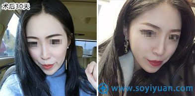 西安晶肤医疗美容埋线提升案例 西安晶肤医疗美容埋线提升案例