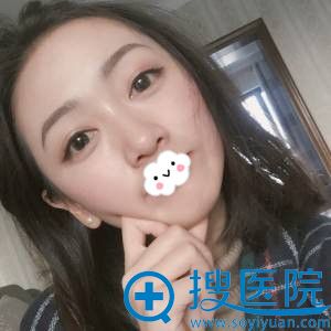 成都医美刘倩双眼皮+开眼角真人案例 成都医美刘倩双眼皮+开眼角真人案例