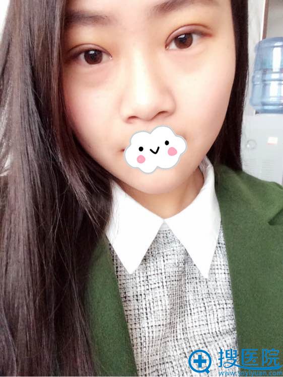 <!--<i data=20240710 data-id=17265></i>-->割双眼皮效果怎么样 <!--<i data=20240710 data-id=17265></i>-->割双眼皮效果怎么样