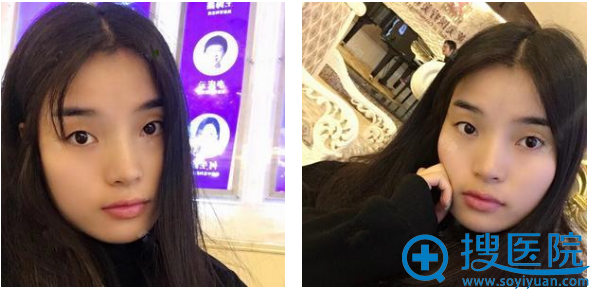 对比了上海伊莱美孙美庆和邱文苑的双眼皮案例后找孙院给我做的