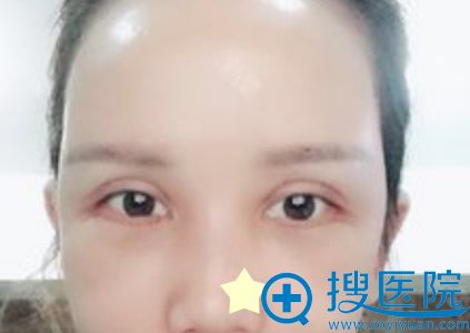 找<!--<i data=20240710 data-id=14184></i>-->韩旭祛眼袋+眶隔释放第3天恢复情况 找<!--<i data=20240710 data-id=14184></i>-->韩旭祛眼袋+眶隔释放第3天恢复情况