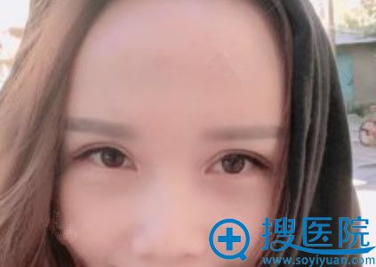 韩旭祛眼袋第15天恢复图 韩旭祛眼袋第15天恢复图