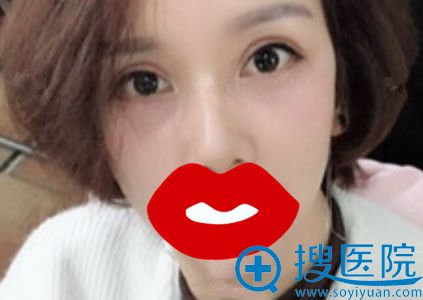 眶隔脂肪释放+祛眼袋第90天效果图 眶隔脂肪释放+祛眼袋第90天效果图