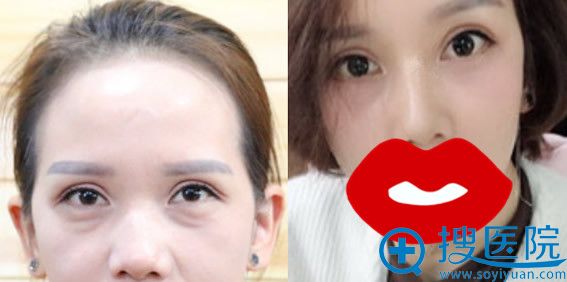 <!--<i data=20240710 data-id=14184></i>-->整形祛眼袋+眶隔脂肪释放前后效果对比 <!--<i data=20240710 data-id=14184></i>-->整形祛眼袋+眶隔脂肪释放前后效果对比