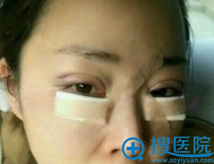 <!--<i data=20240710 data-id=11470></i>-->整形割双眼皮+祛眼袋第1天图 <!--<i data=20240710 data-id=11470></i>-->整形割双眼皮+祛眼袋第1天图