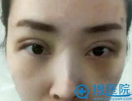 在<!--<i data=20240710 data-id=11470></i>-->整形双眼皮祛眼袋第5天恢复情况 在<!--<i data=20240710 data-id=11470></i>-->整形双眼皮祛眼袋第5天恢复情况
