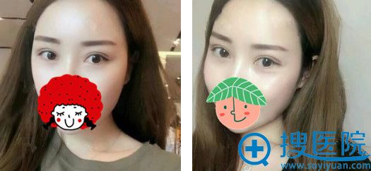 祛眼袋+双眼皮45天恢复效果图 祛眼袋+双眼皮45天恢复效果图