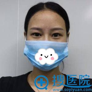 <!--<i data=20240710 data-id=12088></i>-->吴昊双眼皮+开眼角真人案例 <!--<i data=20240710 data-id=12088></i>-->吴昊双眼皮+开眼角真人案例