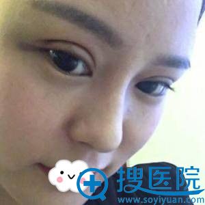 <!--<i data=20240710 data-id=12088></i>-->吴昊眼部综合整形效果 <!--<i data=20240710 data-id=12088></i>-->吴昊眼部综合整形效果