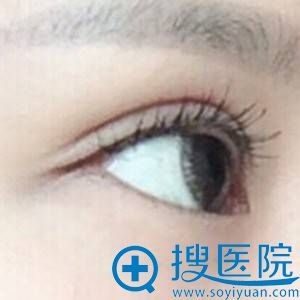 <!--<i data=20240710 data-id=12088></i>-->双眼皮+开眼角真实效果 <!--<i data=20240710 data-id=12088></i>-->双眼皮+开眼角真实效果