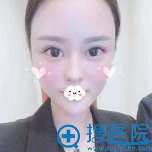 <!--<i data=20240710 data-id=12088></i>-->双眼皮真人案例 <!--<i data=20240710 data-id=12088></i>-->双眼皮真人案例