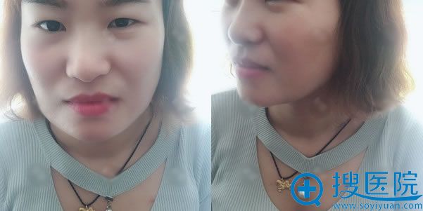 看我在北京金燕子做脂肪填充失败修复效果,40天看不出修复痕迹