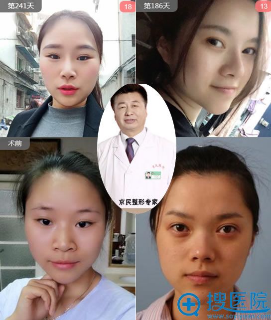 正想找北京做鼻子医生看到北京京民王志坚隆鼻案例和医院价格表