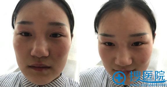 在老家做失败的韩式三点双眼皮 在老家做失败的韩式三点双眼皮