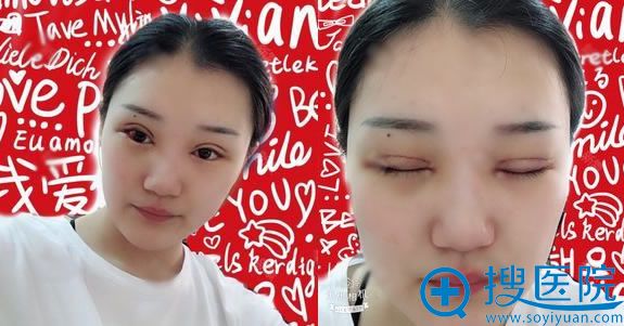 在奥德丽格做双眼皮修复1天效果 在奥德丽格做双眼皮修复1天效果