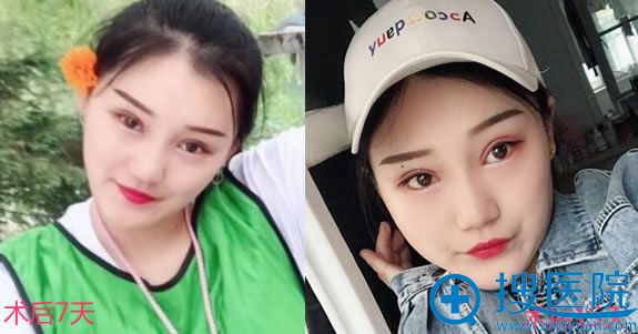 做完双眼皮修复术后2周恢复图 做完双眼皮修复术后2周恢复图