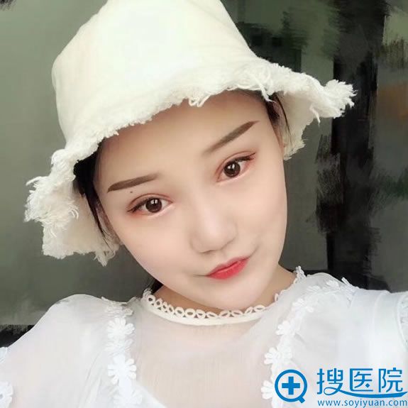 找<!--<i data=20240710 data-id=7735></i>-->马晓艳双眼皮修复20天后 找<!--<i data=20240710 data-id=7735></i>-->马晓艳双眼皮修复20天后