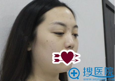 大家觉得青岛江南名佳柳重锡给我做的肋软骨综合隆鼻恢复期短吗