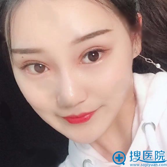 在奥德丽格做双眼皮和眼角恢复40天 在奥德丽格做双眼皮和眼角恢复40天