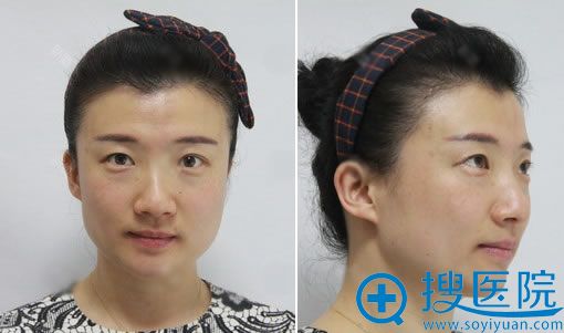 之前做两次埋线双眼皮后效果 之前做两次埋线双眼皮后效果