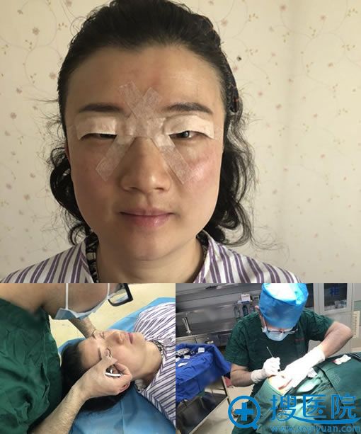 <!--<i data=20240710 data-id=12459></i>-->齐永乐做双眼皮修复图 <!--<i data=20240710 data-id=12459></i>-->齐永乐做双眼皮修复图