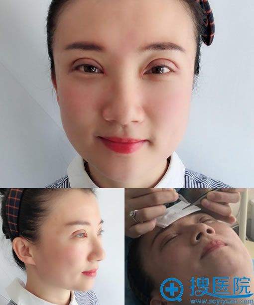 做完开眼角和双眼皮修复7天拆线图 做完开眼角和双眼皮修复7天拆线图